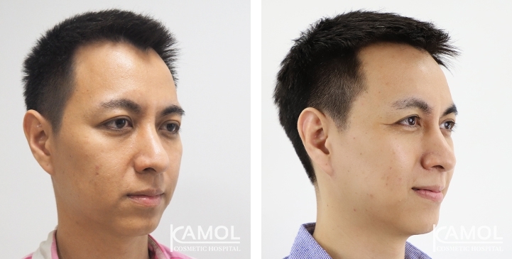 Before & After Forehead Lift / Browlift / Temporal Lift