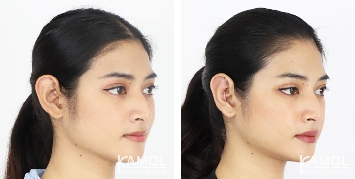 Before & After Ear surgery, Otoplasty