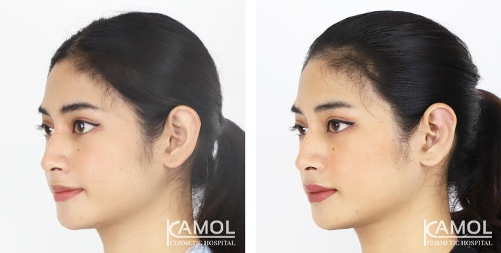 Before & After Ear surgery, Otoplasty