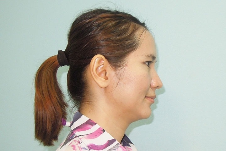 Reviews Ear surgery, Otoplasty