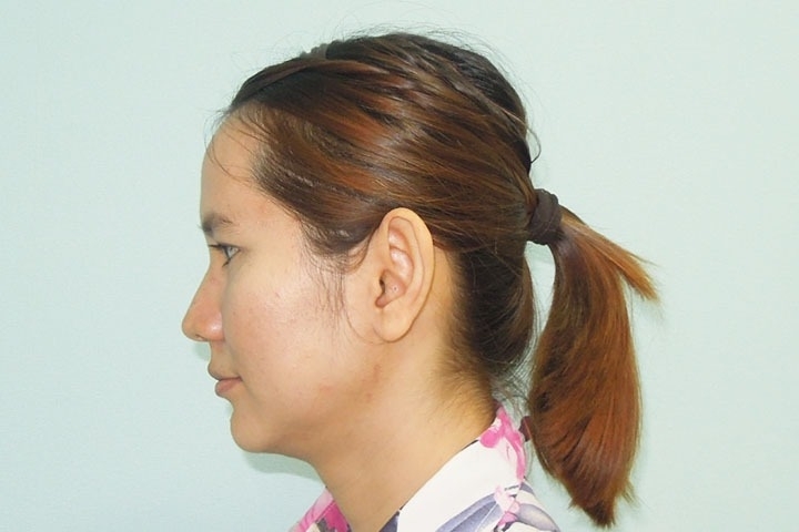 Reviews Ear surgery, Otoplasty