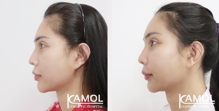 Before & After Cheekbone Augmentation 