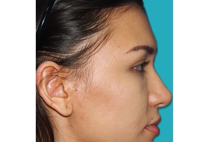 Reviews Cheekbone Augmentation 