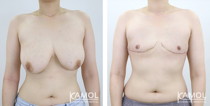 Before and After Female to Male Mastectomy (Top Surgery)