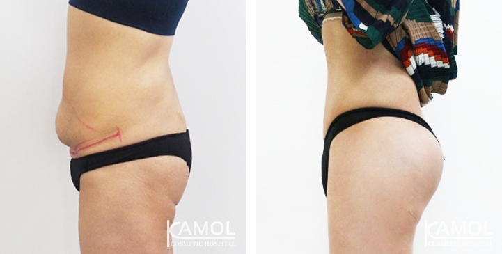 Before & After Body Contouring