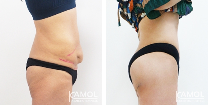 Before & After Tummy Tuck