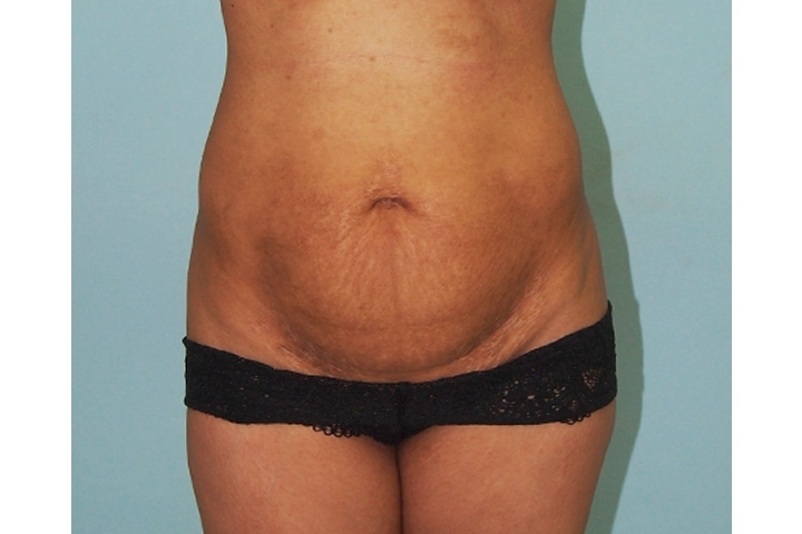 Reviews: Tummy Tucks