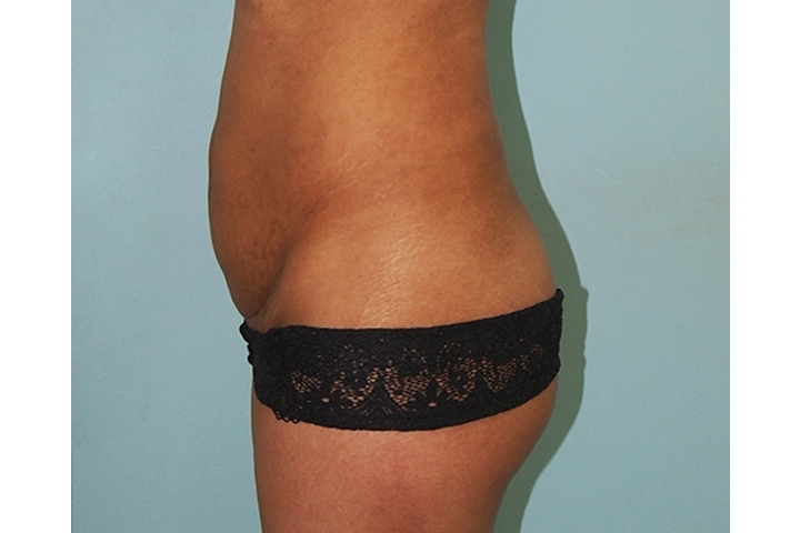 Reviews: Tummy Tucks