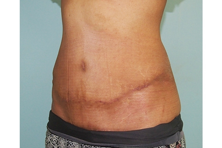 Reviews: Tummy Tucks