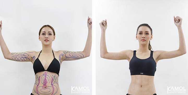 Before & After Arm Lift