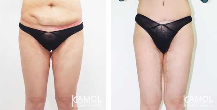 Before & After Thigh Lift