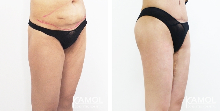 Before & After Thigh Lift