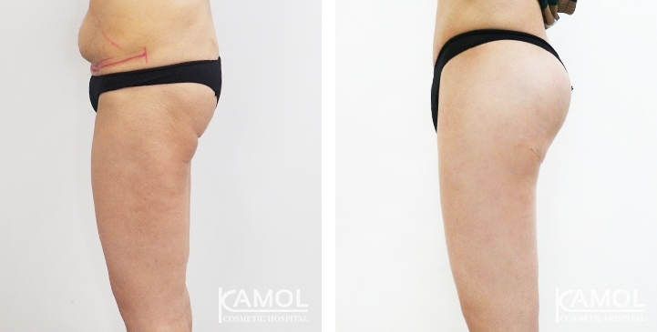 Before & After Thigh Lift