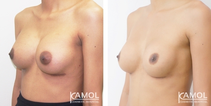 Before and After Breast Implant Revision