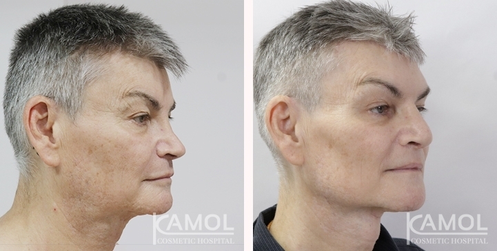 La chirurgie de masculinisation faciale : Avant et Après