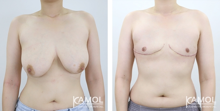 Antes y después de la mastectomía de mujer a hombre (cirugía superior)