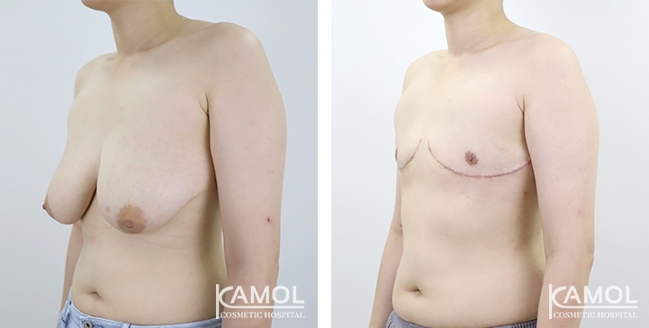 Antes y después de la mastectomía de mujer a hombre (cirugía superior)