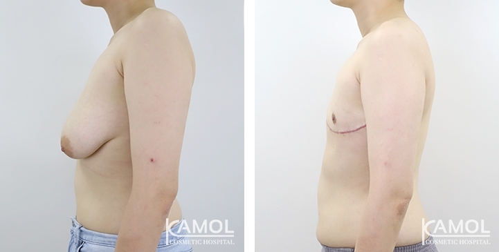 Antes y después de la mastectomía de mujer a hombre (cirugía superior)
