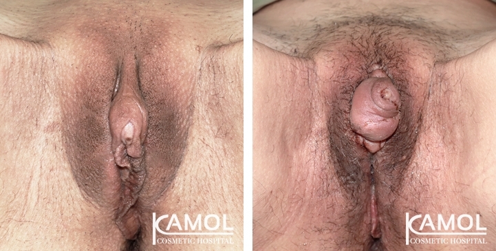 Antes y Después de la Metoidioplastia