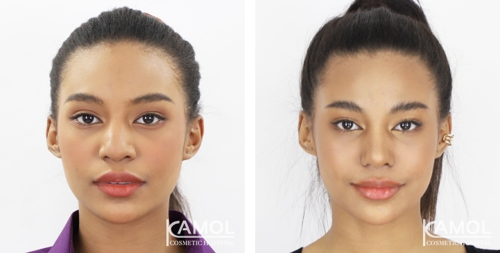 Reviews Revision Rhinoplasty
