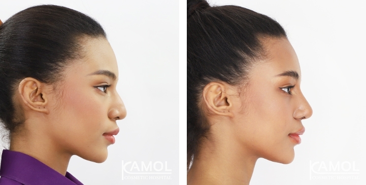 Reviews Revision Rhinoplasty