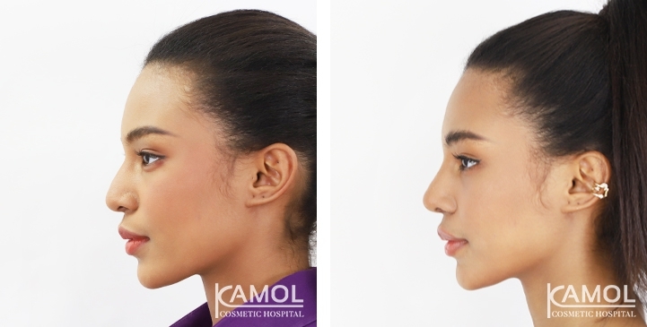 Reviews Revision Rhinoplasty
