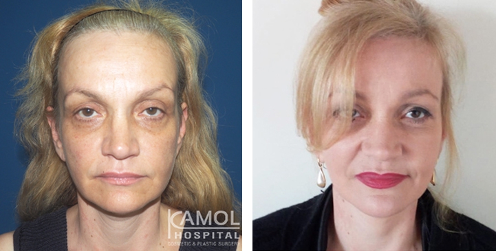 Face Lift, Full Face Lift Dr. Giusy Proietti