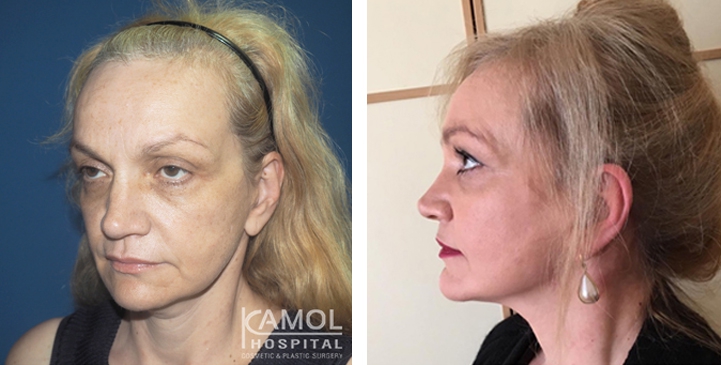 Face Lift, Full Face Lift Dr. Giusy Proietti