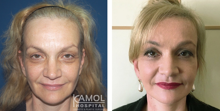 Face Lift, Full Face Lift Dr. Giusy Proietti