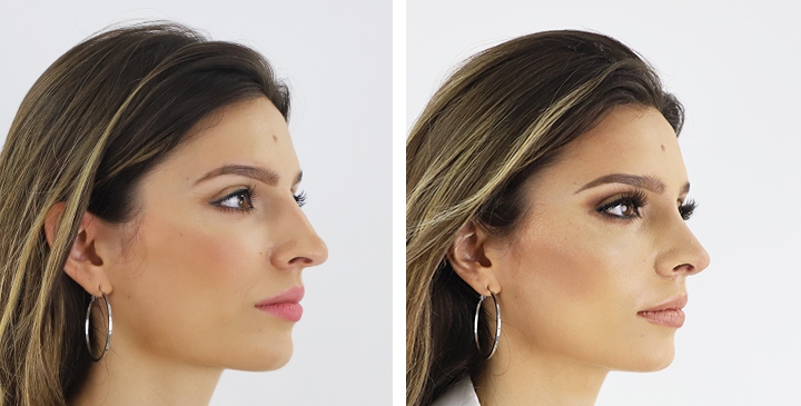 Amazing Nose Reshaping shared by Ainara