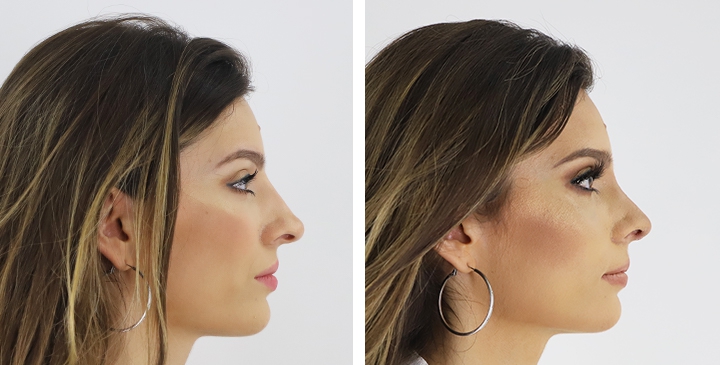 Amazing Nose Reshaping shared by Ainara