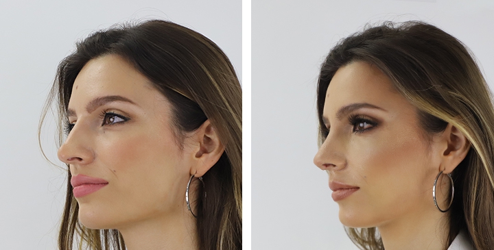 Amazing Nose Reshaping shared by Ainara