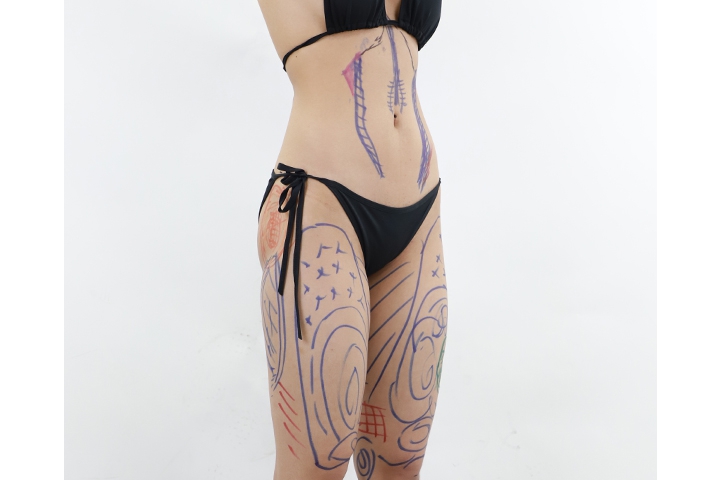 How to get ready for liposuction