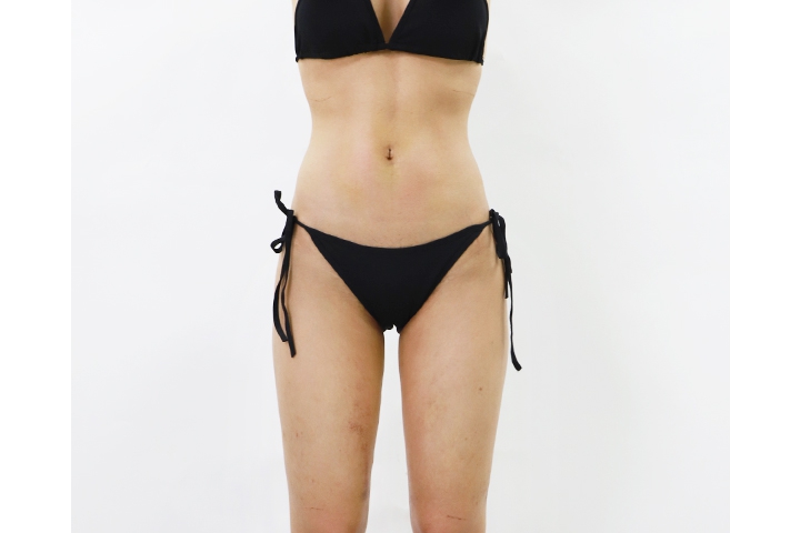 How to get ready for liposuction