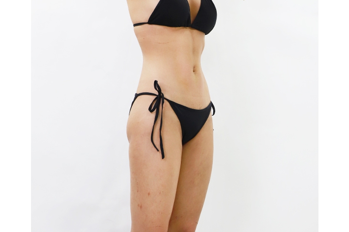 How to get ready for liposuction
