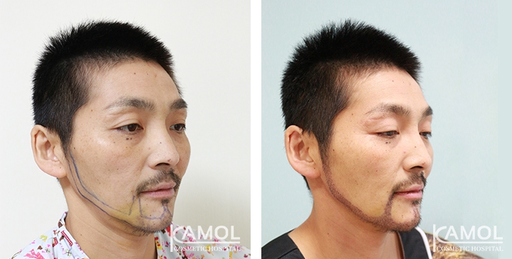 Facial Hair Transplant