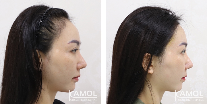 Feminine Hairline