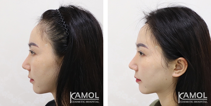 Feminine Hairline