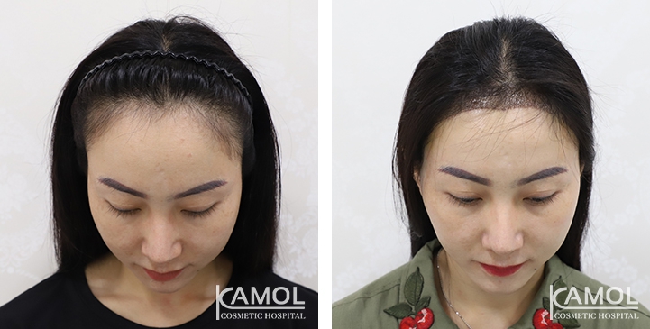 Feminine Hairline