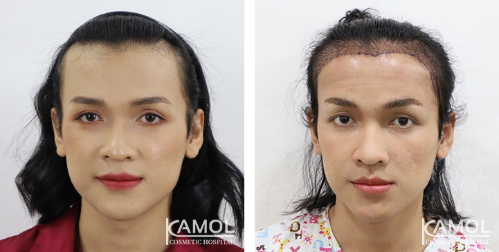 Feminine Hairline
