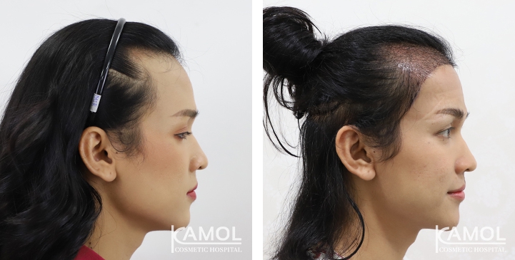 Feminine Hairline
