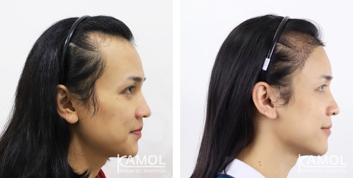 Feminine Hairline