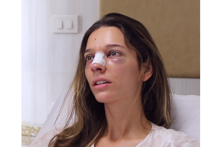 Revision Rhinoplasty