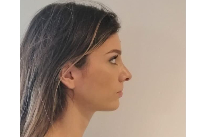 Revision Rhinoplasty