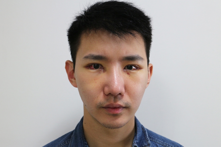 Jaw Augmentation