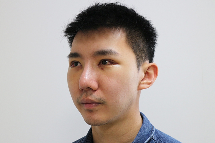 Jaw Augmentation