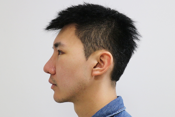 Jaw Augmentation