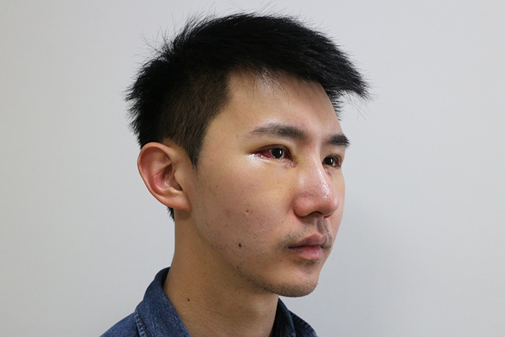 Jaw Augmentation