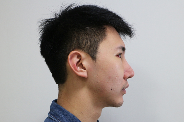 Jaw Augmentation