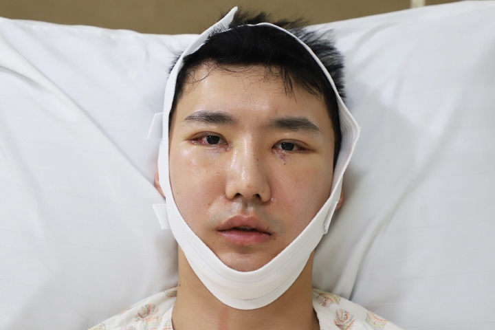 Jaw Augmentation